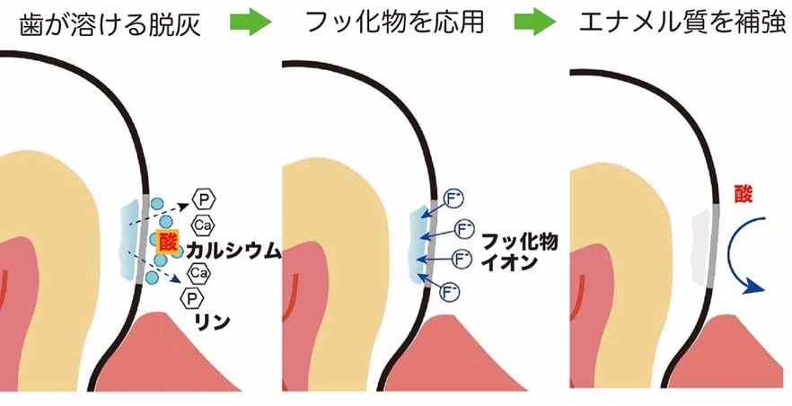 初期う蝕のマネージメント : う蝕を進行させないために - 健康/医学